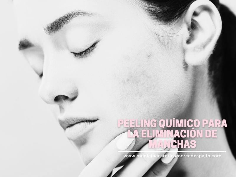 Peeling químico eliminación de manchas